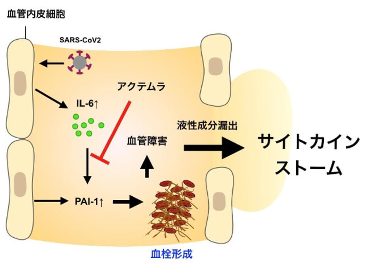 新型コロナ肺炎