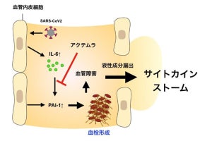 阪大、新型コロナによる肺炎が重症化する仕組みの一端を解明