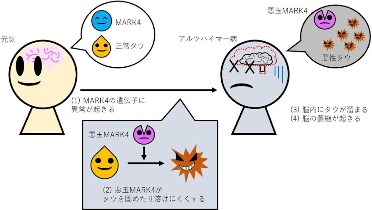 アルツハイマー病