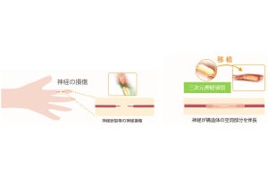京大病院、損傷した手指の末梢神経をバイオ3Dプリンタで再生する治験を開始