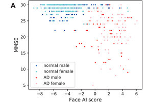 東大病院など、認知症患者と健常者を顔写真で判別できるAIを開発