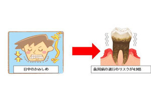 日中に噛みしめると歯周病のリスクは5倍弱に跳ね上がる - 岡山大が確認