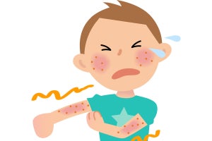 アトピーなどのアレルギー炎症を悪化・長期化させる因子を日大などが特定