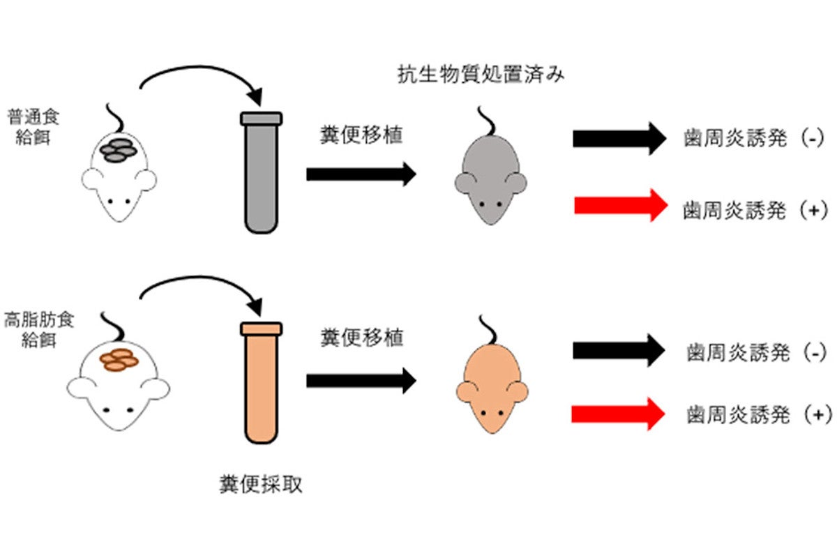 肥満による腸内細菌叢の変化が歯周病を悪化させることを新潟大などが