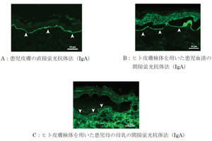 「新生児線状IgA水疱性皮膚症」の原因抗体は母乳内にあった、慶大が特定