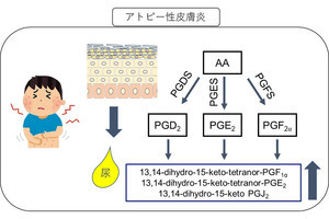 東大、アトピー性皮膚炎の尿中で濃度が上昇している脂質代謝物3種類を発見