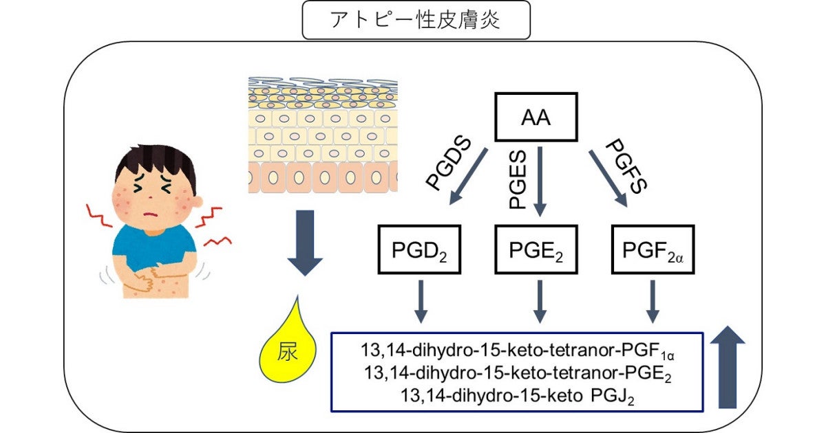 東大 アトピー性皮膚炎の尿中で濃度が上昇している脂質代謝物3種類を発見 Tech