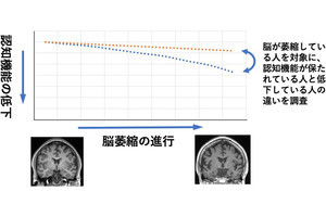 脳が萎縮しても認知機能を維持できる人の特徴は何か？、京大が調査