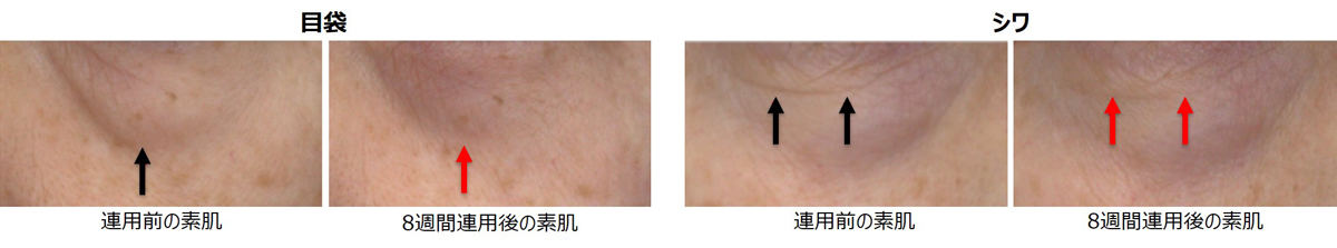 連用によるたるみ・シワ改善効果