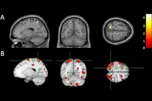 不適切な養育を受けた子供のDNA配列が一般の子供と異なる可能性、福井大などが確認