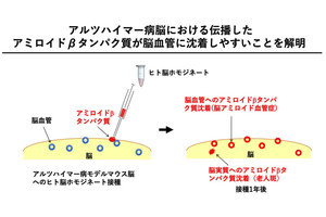 アルツハイマー病脳の沈着したAβは別個体の脳血管にも沈着しやすい、金沢大が確認