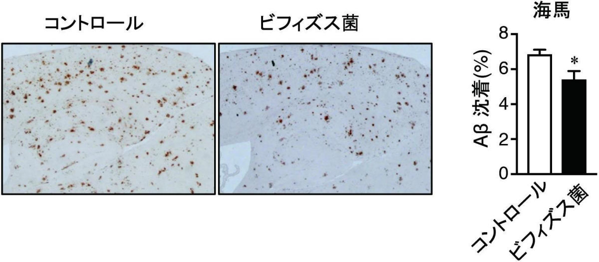 アルツハイマー病