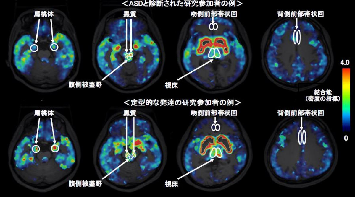 自閉スペクトラム症