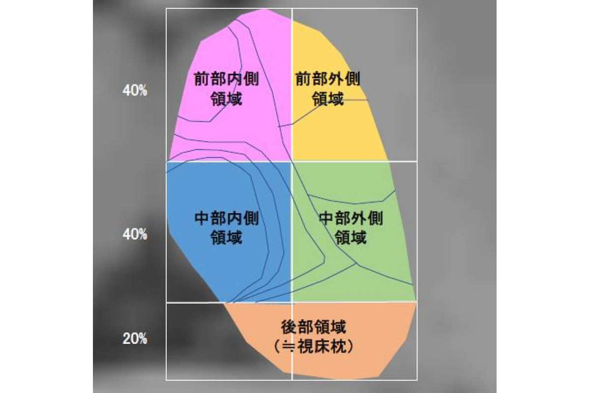 自閉スペクトラム症