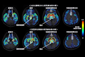 ASD患者脳内ではドーパミン受容体が減少、社会的コミュニケーションの困難に関与
