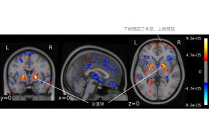 東大、機械学習を用いて脳画像データから統合失調症を判別できる手法を開発