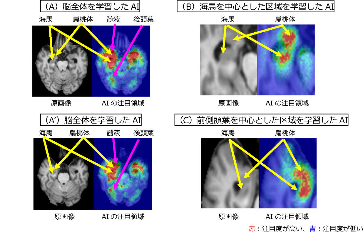 AIがアルツハイマー病への進行を予測する上で注目した微細な萎縮パターン
