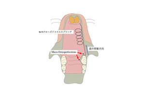 「歯茎の骨に穴」で、歯の移動を促す仕組みを解明 矯正治療の期間短縮へ