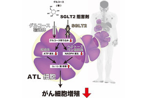 超難治性の血液がんに糖尿病治療薬が効果を発揮する可能性、琉球大が確認