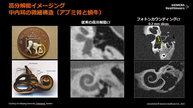 従来の高分解能CTと比較した際の中内耳の構造画像