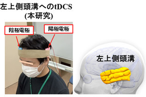 統合失調症患者の社会認知機能が経頭蓋直流刺激で改善、NCNPが確認