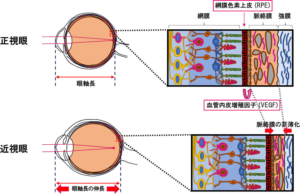 近視眼で見られる眼軸長の伸長は脈絡膜の菲薄化によって進行する