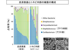 ニキビ内部には多様な菌が生息、藤田医科大などが確認