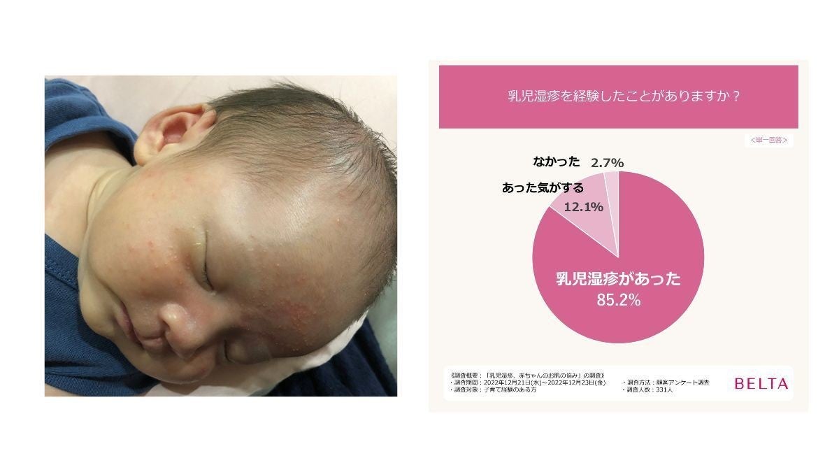 ベルタ 子育て経験者への 乳児湿疹 赤ちゃんの肌の悩み を調査 97 以上が乳児湿疹を経験 Tech テックプラス