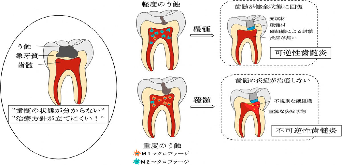 これまで歯髄炎の病態については不明な点が多く、そのため歯髄炎に罹患した場合の第一選択は歯髄除去療法だった。しかし、う蝕誘発ラットの解析で再現性高く歯髄炎を惹起することに成功。さらに、可逆性・不可逆性歯髄炎を特徴づけるマクロファージの局在についても見出され、今回、歯髄炎の動物実験モデルの確立に世界で初めて成功した