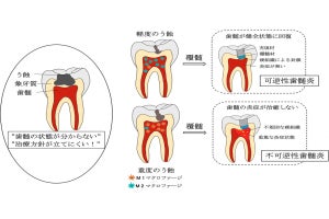 阪大、むし歯に伴う可逆性/不可逆性歯髄炎の動物実験モデルを確立