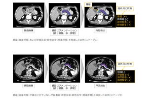富士フイルムなど、AIで造影CT画像から膵臓がん検出を支援する技術を開発