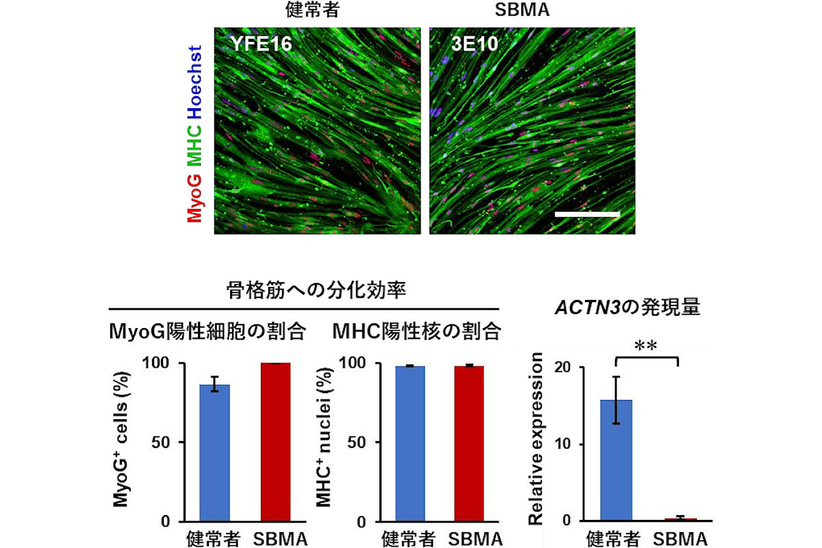 SBMA患者由来iPS細胞の骨格筋への分化誘導とACTN3遺伝子の発現低下(速筋の減少)。