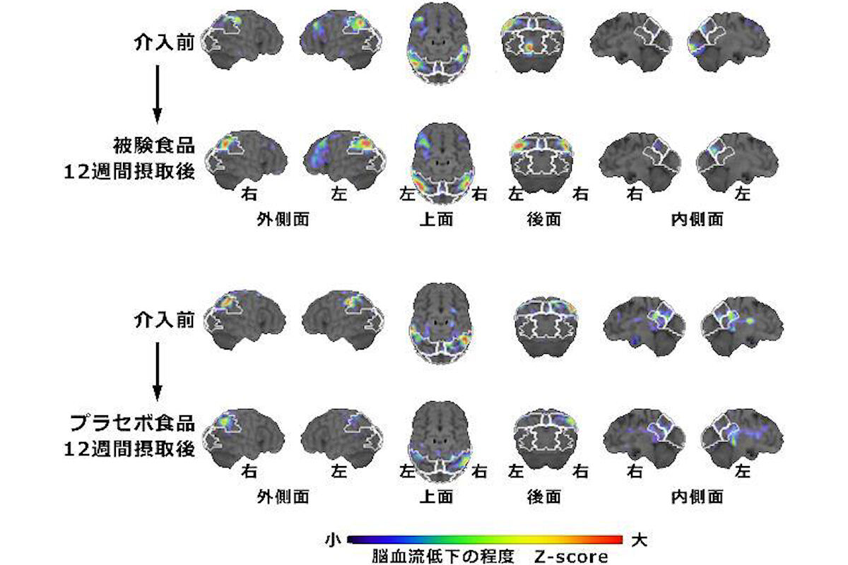 脳血流シンチ検査。赤いほど血流低下が大きい。