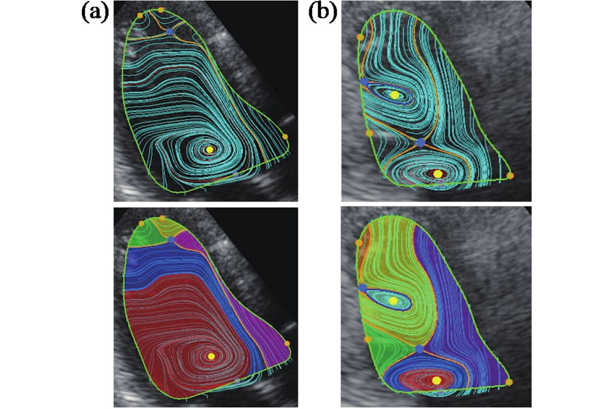 健常な心臓と心不全患者の心臓の心エコーVFMデータとTFDAで得られた渦流領域
