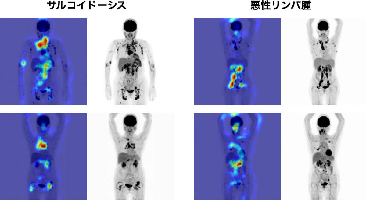 正答例におけるGrad-CAMによるMIP画像のヒートマップ。