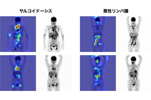 TMDU、困難だったサルコイドーシスと悪性腫瘍を鑑別するAIモデルを開発