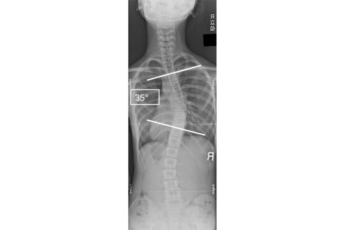東大とZOZO、患者1人でいつでも「脊柱側弯症」を検査できる仕組みを 