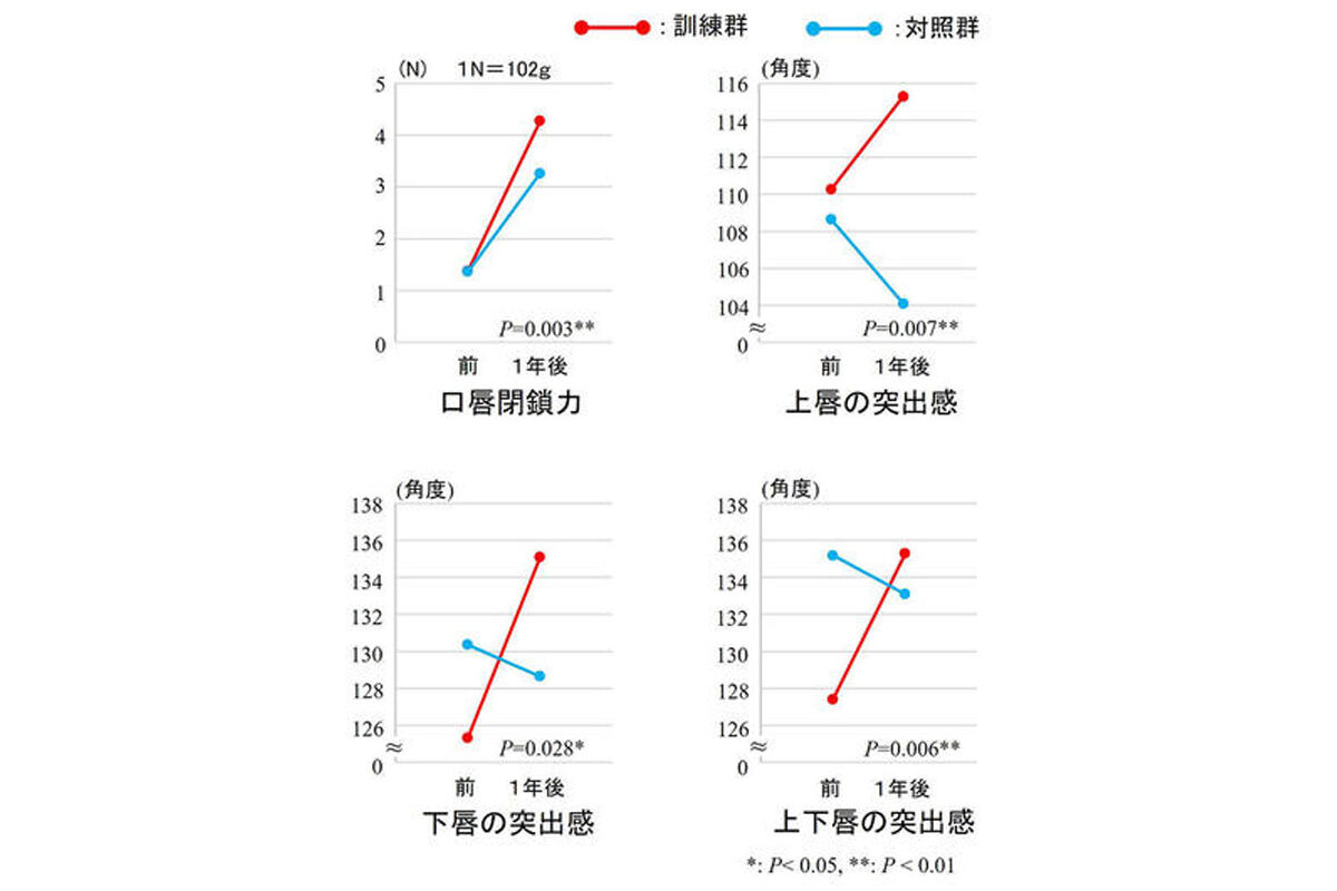 お口ぽかんの子どもの口唇閉鎖力と口元の形の変化。