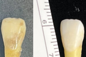 近大など、エナメル質を治しながら数秒で歯を白くする審美修復技術を開発