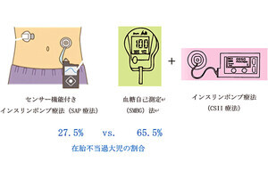 神戸大、1型糖尿病女性患者の妊娠時に「SAP療法」が有効と証明