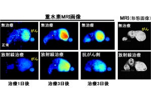 岐阜大など、「重水素MRI法」でがんの治療成果を素早く検出可能と発表