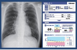 富士通×iSurgery、胸部X線写真を活用した「骨の健康増進プロジェクト」
