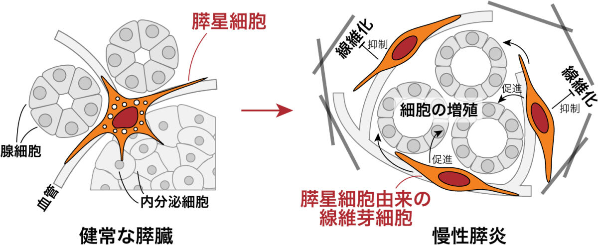 健常な膵臓(左)と慢性膵炎の膵臓(右)の模式図。