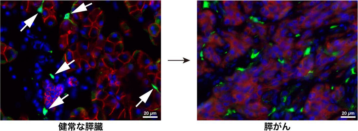 (左)遺伝子組み換えマウスの健常な膵臓で、メフリンを持つ膵星細胞が蛍光タンパク質(緑色)でラベルされた様子(矢印)。(右)同マウスに、膵がん細胞を移植して膵がんを発生させると、緑色の膵星細胞の子孫が、線維芽細胞(がん関連線維芽細胞)となっていることが確認された(赤色は膵臓の上皮細胞およびがん細胞、青色は細胞核)。