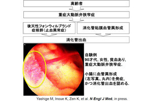 「大動脈弁狭窄症」に伴う消化管出血はカテーテル治療で改善、京府医大など