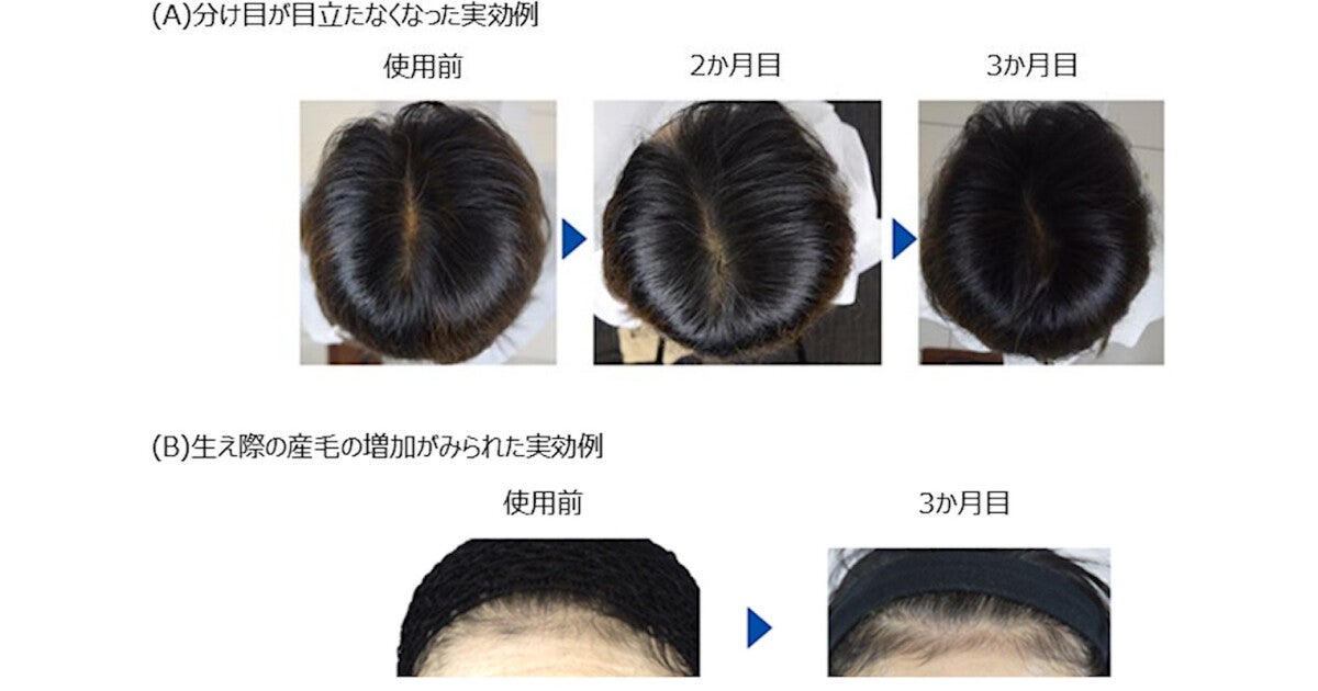 その他の部分では モウソウチクたけのこ皮エキス ミツバアケビ茎エキスなどの整肌作用