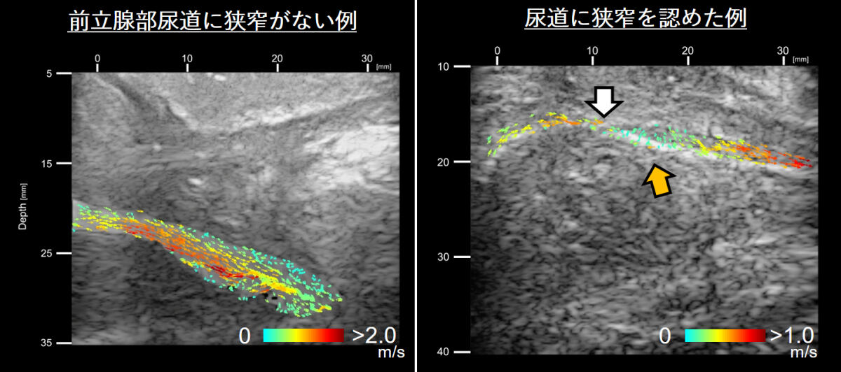 CE-UroVPI法により可視化された、尿道内部の狭窄と渦流の状態