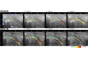 東北大、高速度超音波撮像技術により尿道内排尿流のベクトルを可視化