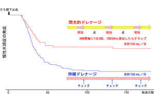 くも膜下出血後の脳脊髄液ドレナージは間欠的な方が有効の可能性、名古屋市立大が報告