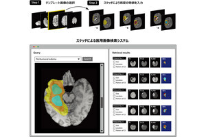 国がん、膨大なCT・MRIの画像をスケッチにより検索するAIを開発